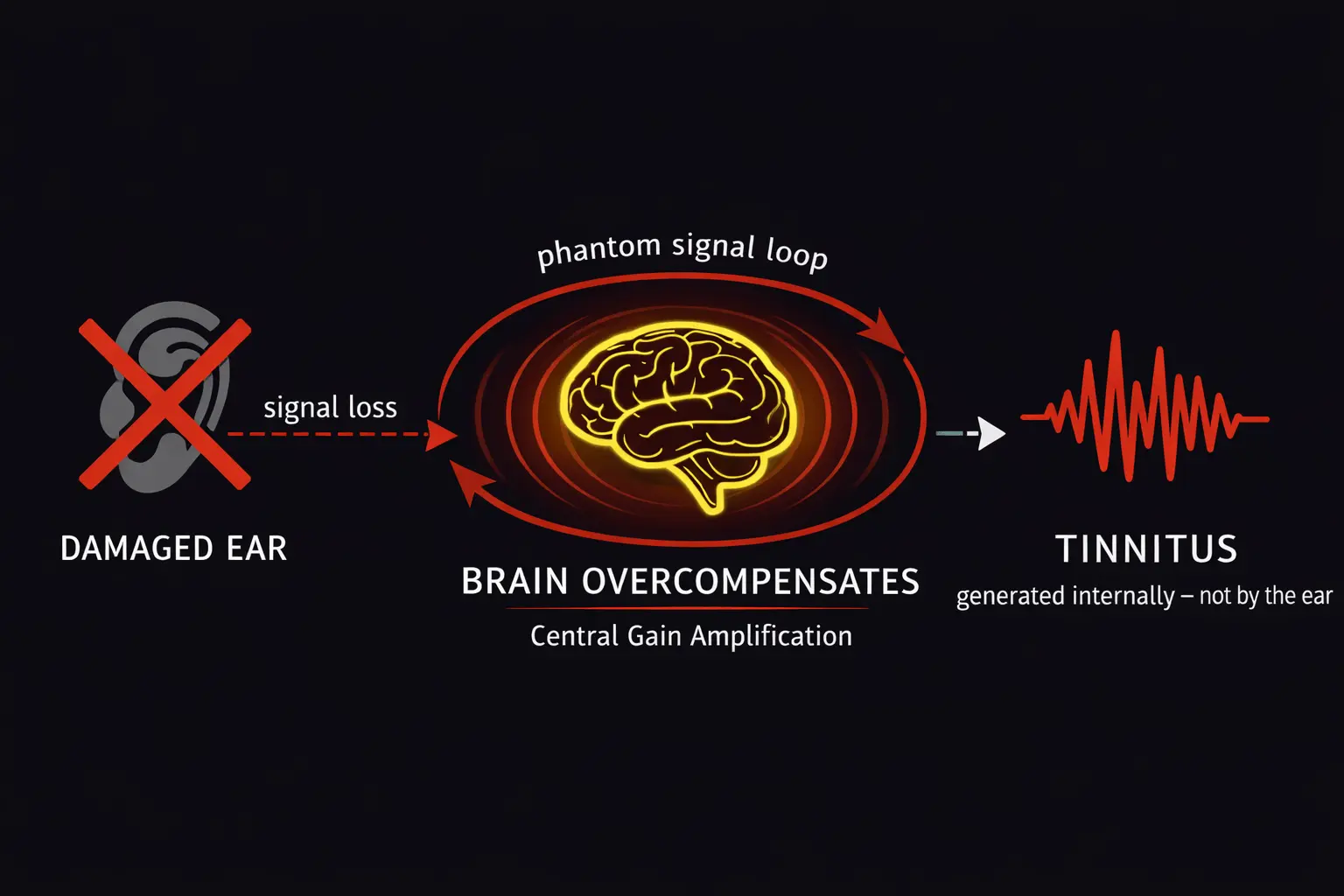 Brain regions implicated in chronic tinnitus signal generation